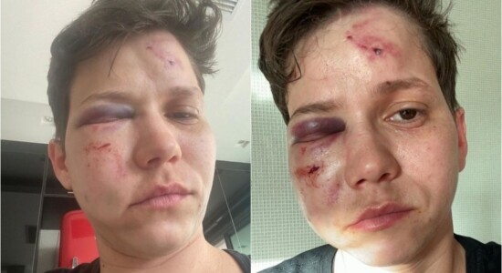 Polícia descartou homofobia em agressão contra Karol Eller