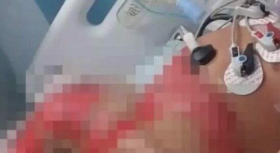Bebê de seis meses sofre queimaduras em hospital