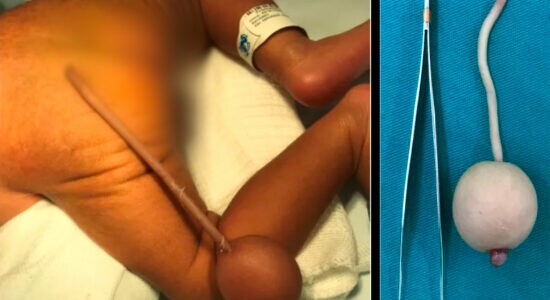 Bebê brasileiro nasce com cauda de 12 cm e bola de 4 cm na ponta