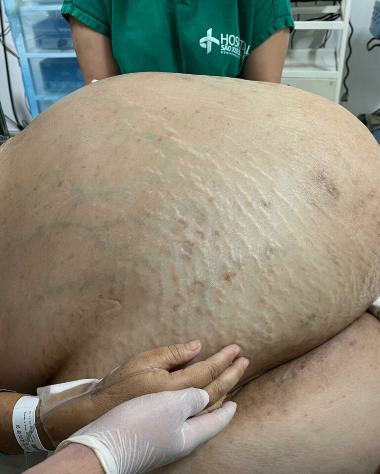Tumor de 46 kg é retirado de mulher em cirurgia